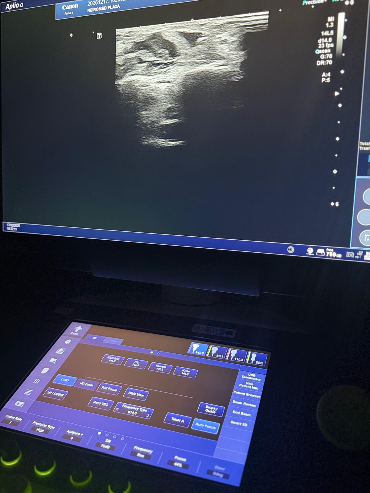 Perifēro nervu ultrasonogrāfija neiromed neiroklinika (1)