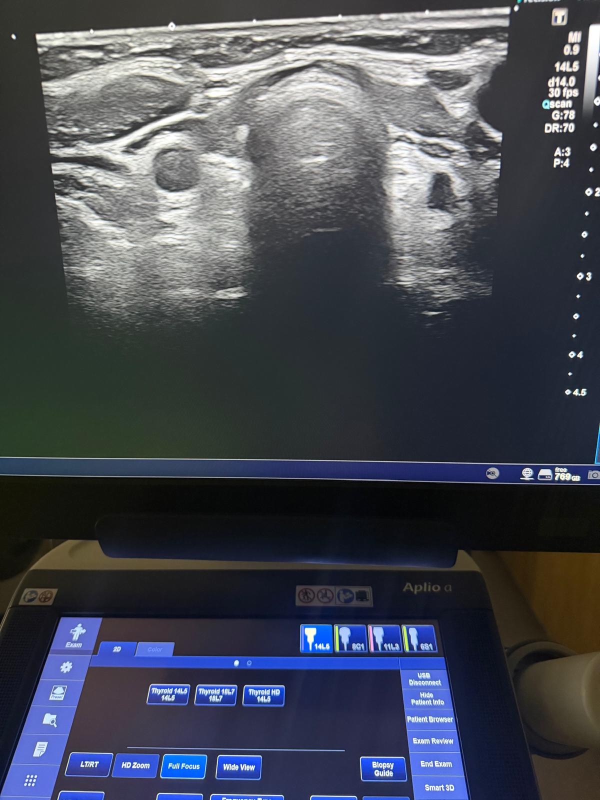 Vairogdziedzera ultrasonogrāfija neiromed plaza pakalpojums (4)